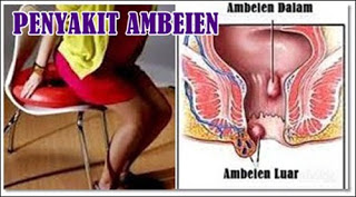 Manfaat Cuka Apel Buat Wasir