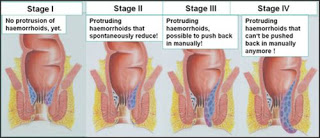 Cara Menyembuhkan Benjolan Wasir Dengan Cepat