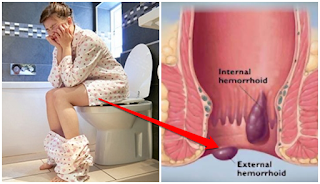 Ciri Ciri Wasir Stadium 4